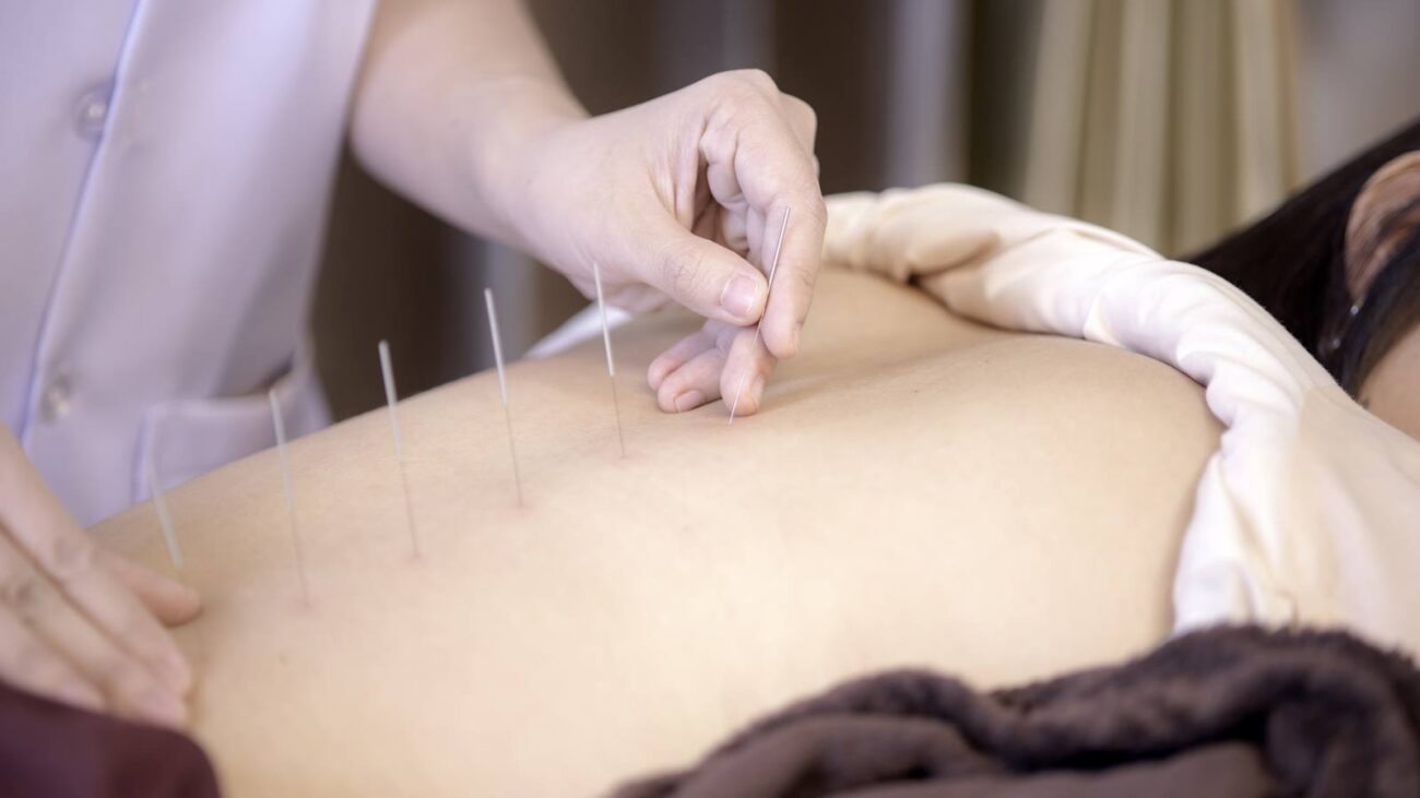 women girl acupuncture dry needling therapy