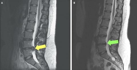 l4 l5 s1 disc bulge treatment without surgery in hindi